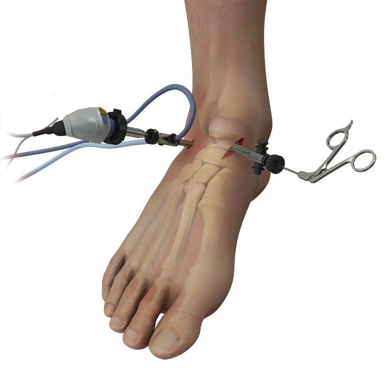 Best Ankle Arthroscopy Surgeon in Noida