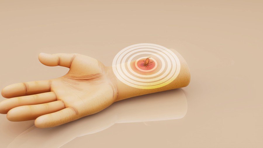 Illustration of wrist pain and nerve compression in the carpal tunnel